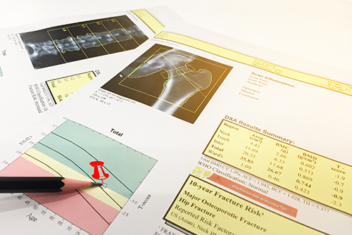 Hip and Spine Bone mineral density (BMD) DEXA densitometry hip s